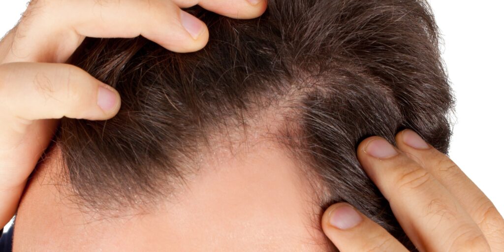 Does Cocaine Cause Hair Loss