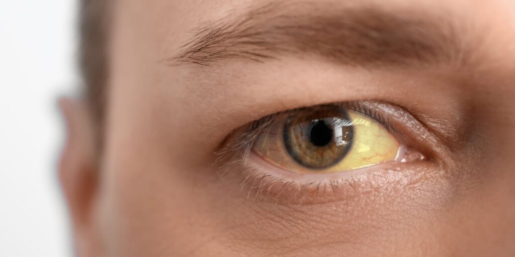 What Do Alcoholic Eyes Look Like