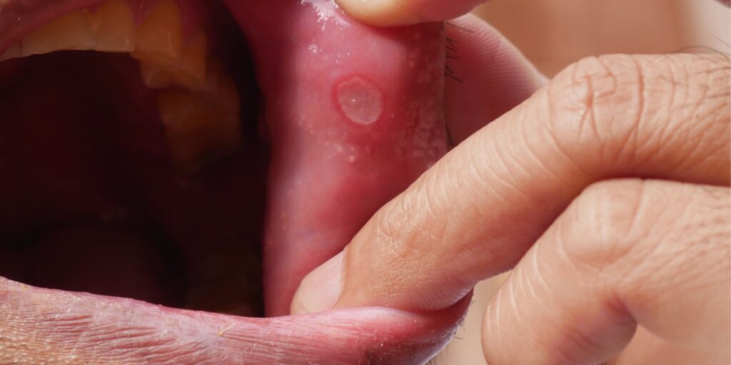 Why Do I Get Mouth Ulcers After Drinking Alcohol