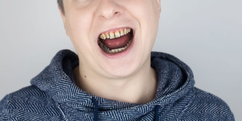 What Does Cocaine Do To Your Teeth