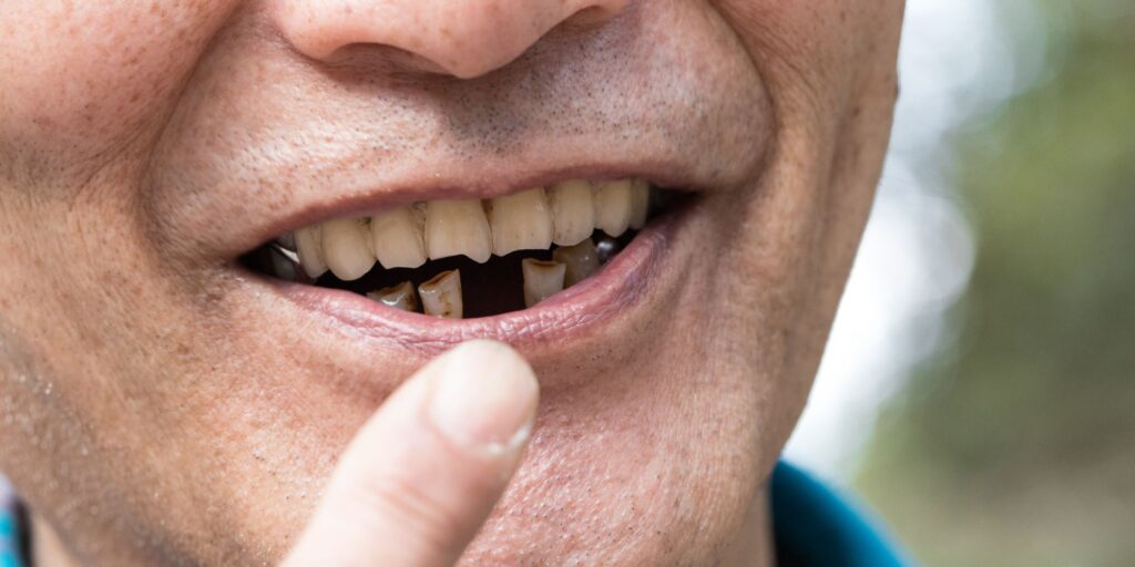 What Does Heroin Do To Your Teeth